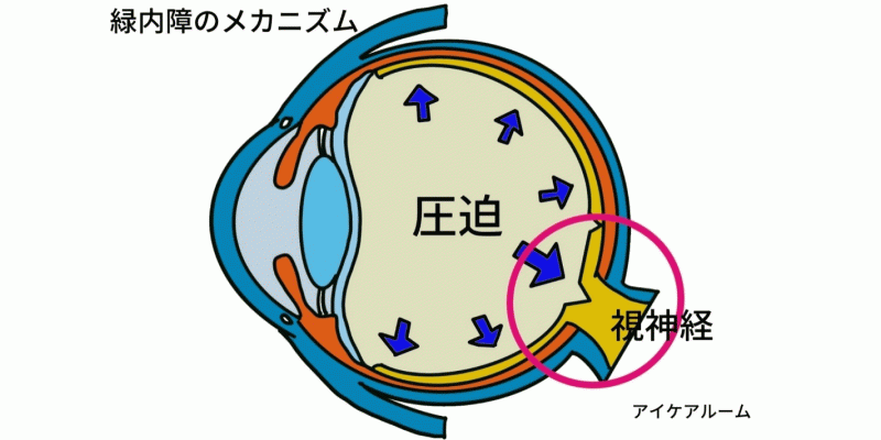 緑内障のメカニズム