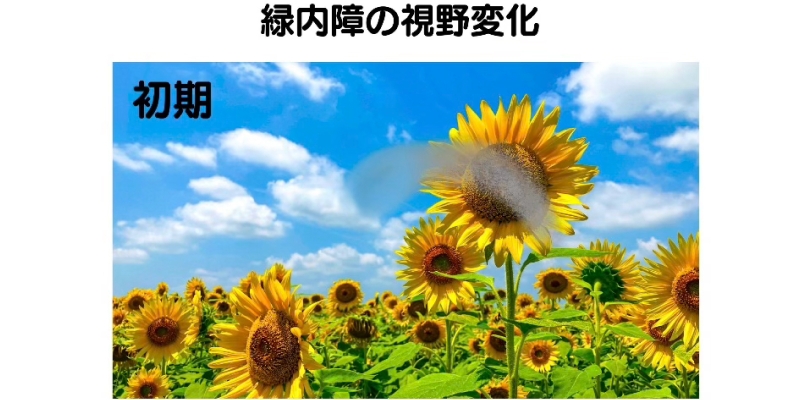 緑内障の視野変化